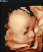 超音波診断装置（Voluson S8）４D画像の1カット 